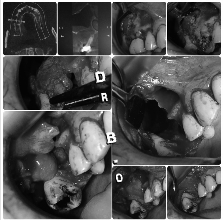 Exérèse chirugicale d'un kyste apical expansif intrasinusien