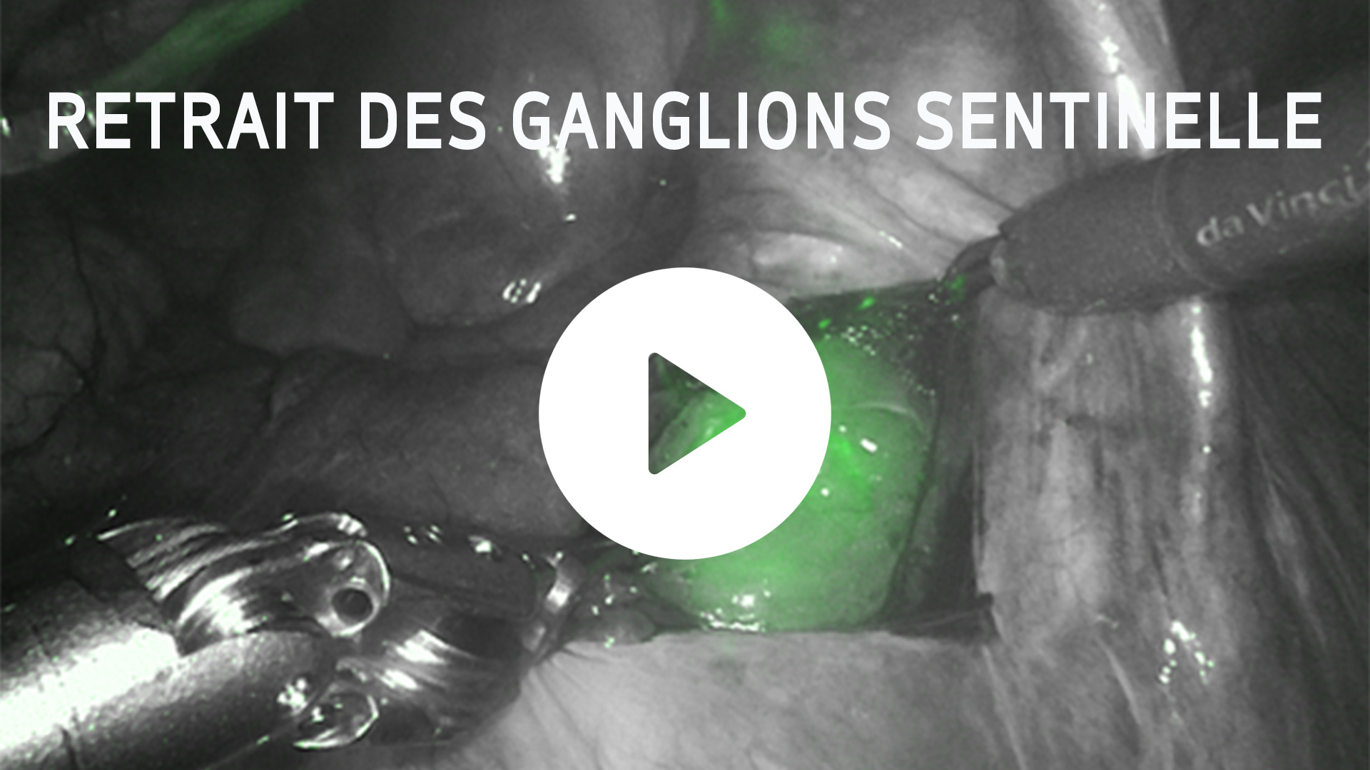 ganglions-sentinelle Retrait des ganglions sentinelle chirurgie robotique
