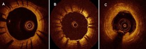 Exemples d’analyses OCT de stents à 6 mois : A : couverture fin et homogène des mailles du stents. B : insuffissance de couverture avec des mailles restant à nues dans la lumière du vaisseau : aspect « crenelé ». C : aspect OCT de resténose. La couverture endothéliale est trop importante, réduisant la lumière résiduelle.