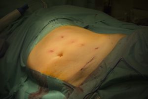 Offrant un impact esthétique moindre, l’utilisation du robot permet d’obtenir un raccourcissement significatif du temps de cicatrisation et de convalescence.Offrant un impact esthétique moindre, l’utilisation du robot permet d’obtenir un raccourcissement significatif du temps de cicatrisation et de convalescence.