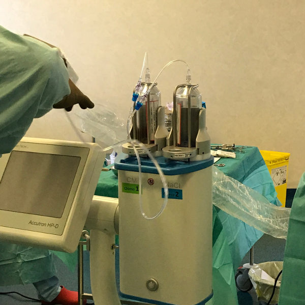 IMG_0370 Une buse de nébulisation reliée à un injecteur haute pression diffuse la chimiothérapie dans tout l’abdomen, puis le produit est laissé pendant une demi-heure dans le corps du patient avant d’être aspiré.